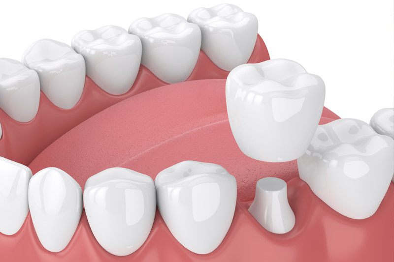 Dental Crowns in Seattle