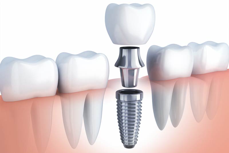 Implants Dentist in Seattle
